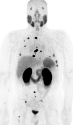 Scientists at UCSF Study Impact of 68Ga-PSMA-11 PET on Post Radical Prostatectomy (RP) Salvage Radiotherapy